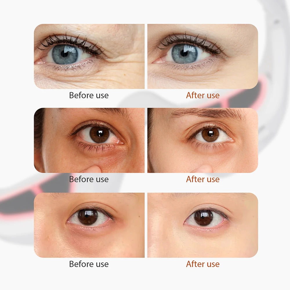 Eye Massager Dark Circles Eye Bag Removal